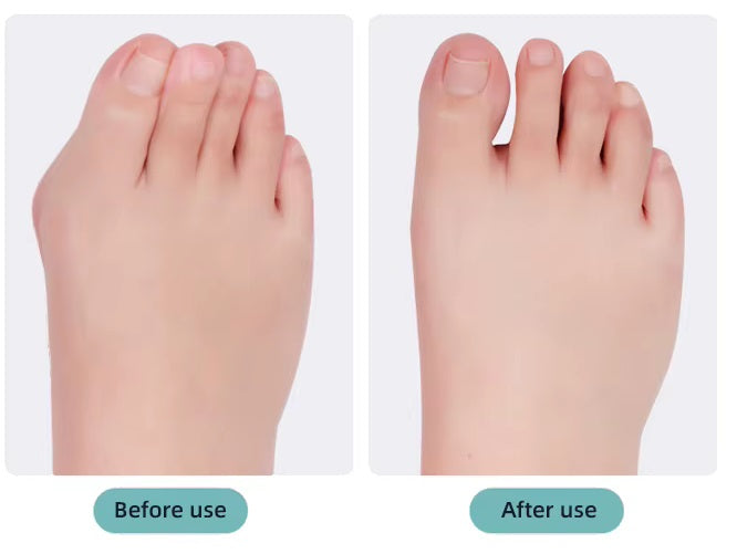 Bunion Corrector & Big Toe Straightener Splint FeetiFix-4576